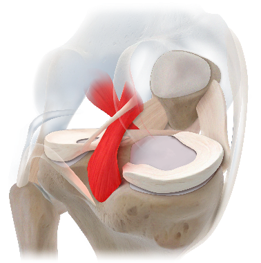 膝关节韧带损伤与术式